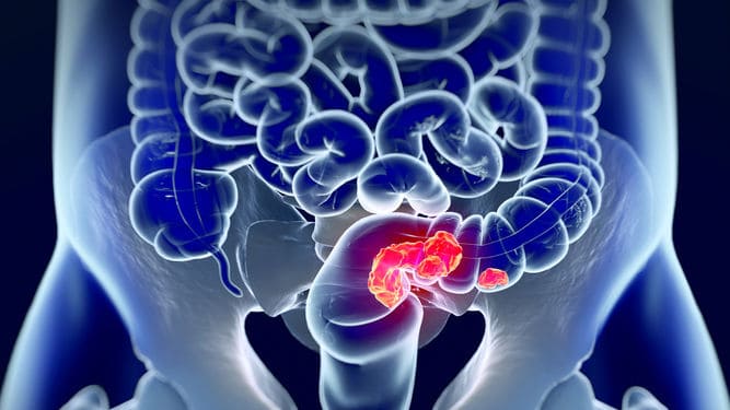 consejos para la prevencion de cancer de colon