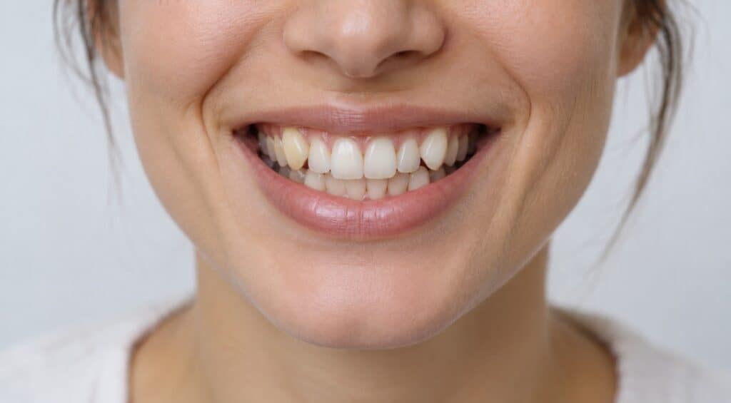 Apiñamiento dental como posible señal para valorar ortodoncia